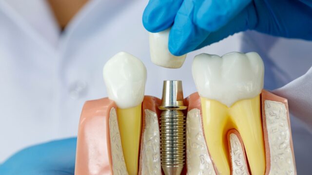 modelo de implante dental